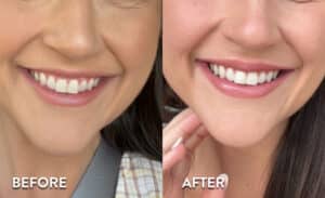 Botox lip flip - before and after photos