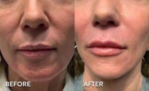 Cheek and Lip Filler - Before and after photos
