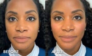 Cheek Filler Before and after photos