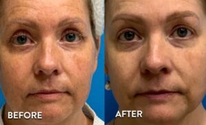 Getting IPL Photofacial in Atlanta - Before and After photos