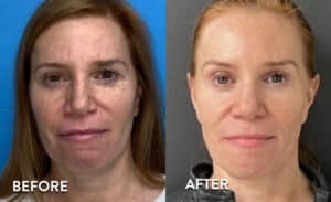 Getting IPL Photofacial in Atlanta - Before and After photos
