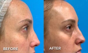 Getting IPL Photofacial in Atlanta - Before and After photos