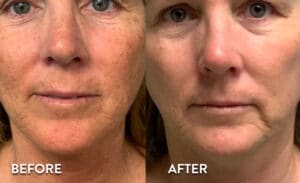 Getting IPL Photofacial in Atlanta - Before and After photos
