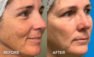 Getting IPL Photofacial in Atlanta - Before and After photos