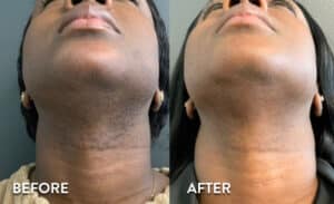 Laser Neck Hair Removal in Atlanta - Before and After Photos