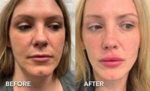 Lip Filler & Botox in Atlanta - Before and After Photos