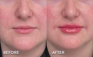 Lip Filler in Atlanta - Before and After Photos
