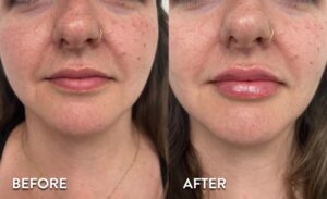 Lip Filler in Atlanta - Before and After Photos