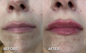 Lip Filler in Atlanta - Before and After Photos