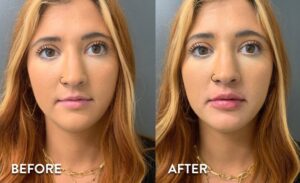 Lip Filler in Atlanta - Before and After Photos