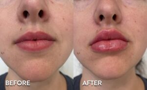 Lip Filler Before and After Photos