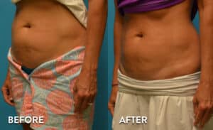 Sculpsure Atlanta Results - Before and After Photos