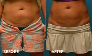 Sculpsure Atlanta Results - Before and After Photos