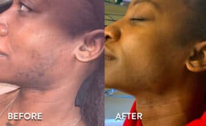 Face / Sideburns Laser Hair Removal Before and After