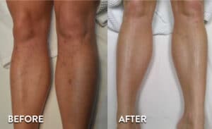 Laser Leg Hair Removal Before and After Picture