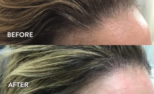 PRP for Hair Loss Before & After