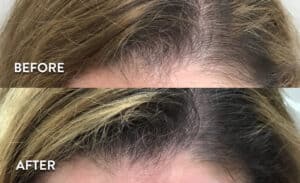 PRP Frontal Hair Loss Treatment Before and After