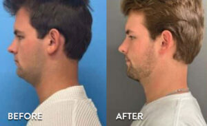 Smartlipo Chin Before & After