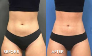 Atlanta Smartlipo Abdomen Before and After Photo