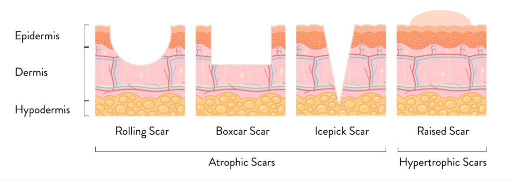 Types of acne scars