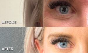 Treating Crow's Feet with Botox in Atlanta- Before and After photos