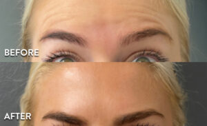 Dysport for forehead wrinkles - Before and After photo