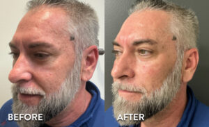 Dermal filler and PRP - Ozempic face Before & After