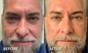 Dermal filler and PRP - Ozempic face Before & After