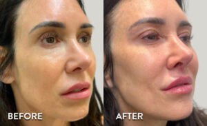 Sculptra and Filler - Ozempic Face Before & After