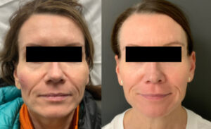 Sculptra - Ozempic Face Before & After