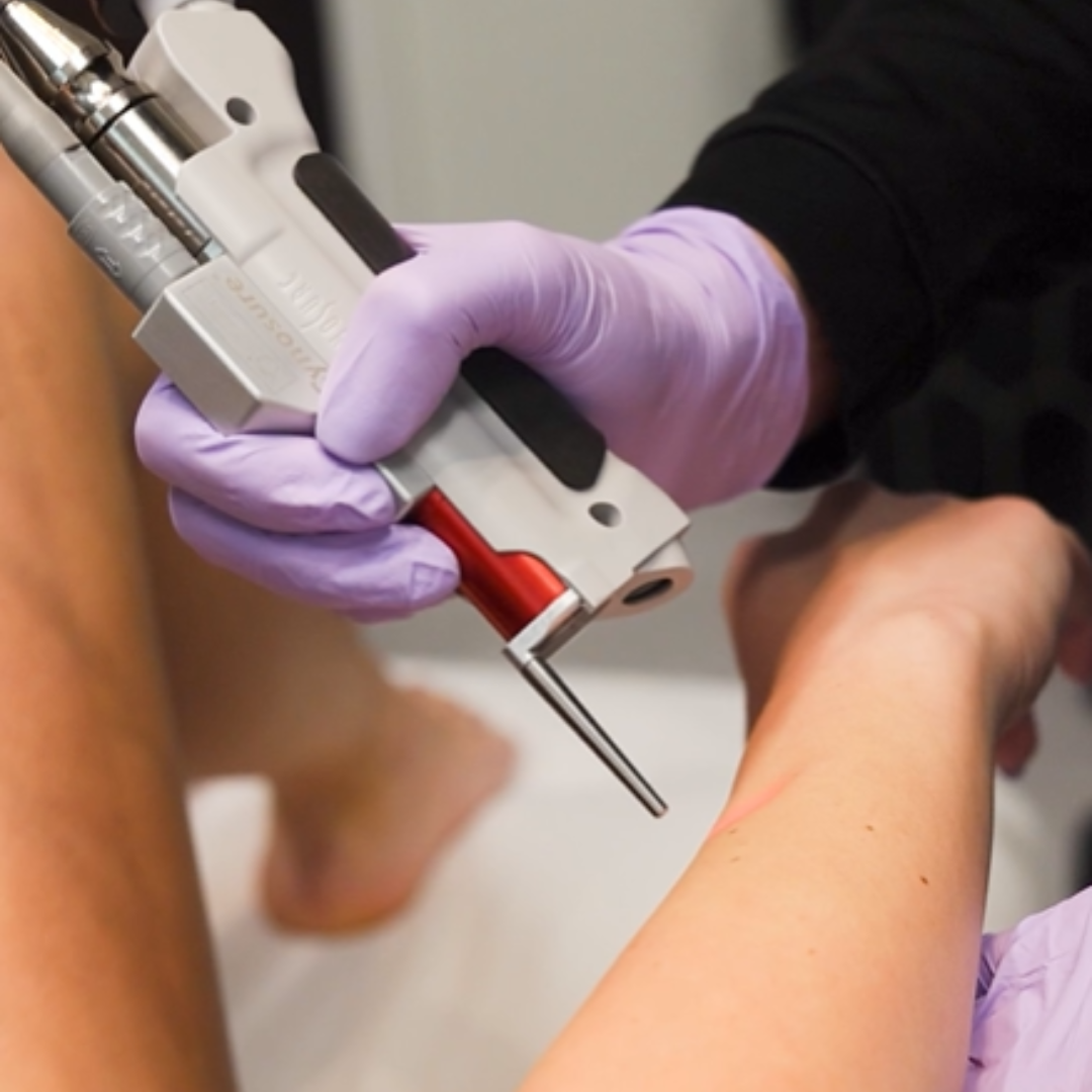 May Special Up to 65% Off Laser Hair Removal Packages - Image 4