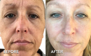 Vi Peel Toxbooster - before & after