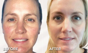 Vi Peel Toxbooster - before & after