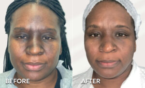 Vi Peel Toxbooster - before & after