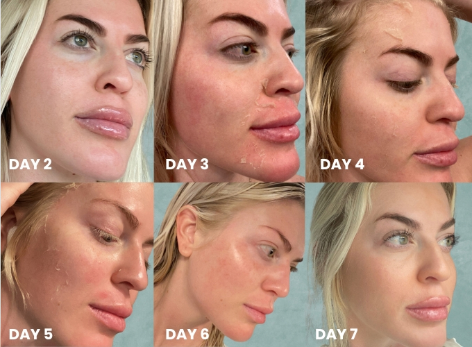 VI Peel Tox Booster Risks & Side Effects