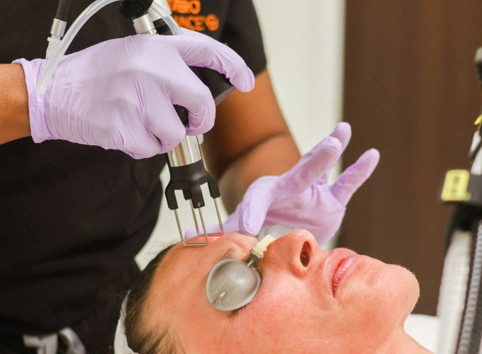 Fractional CO2 PureGF and PRP add-ons