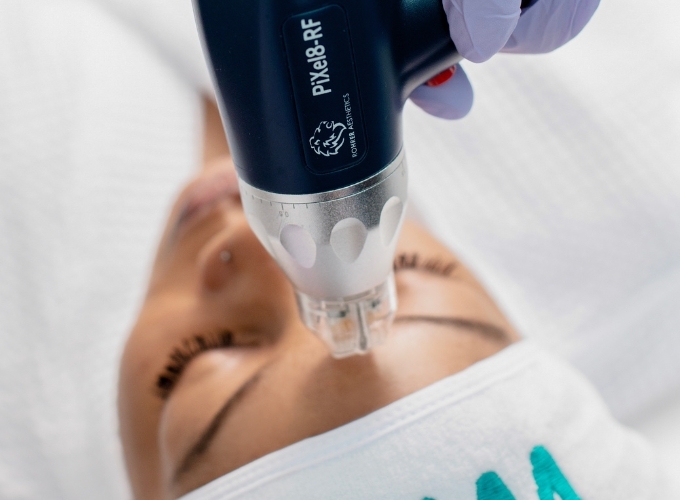 What to Expect During RF Microneedling in Atlanta