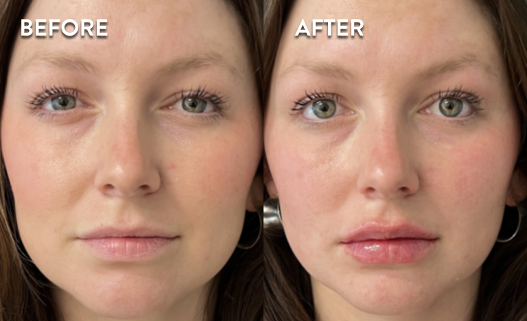 Restylane-Before-and-After