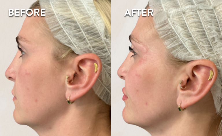 Restylane-Before-and-After