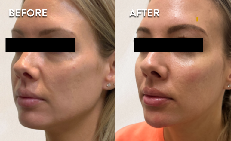 Restylane-Before-and-After