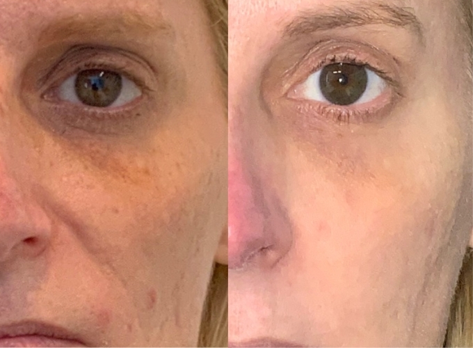 Before and After PRP Eye