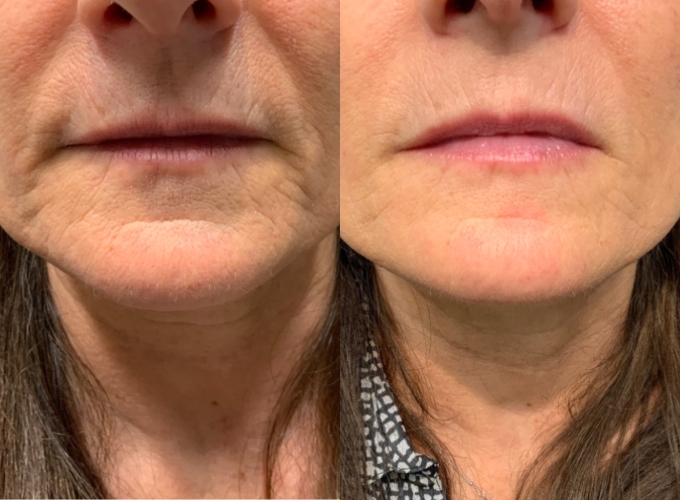 Before and After PRP Lips