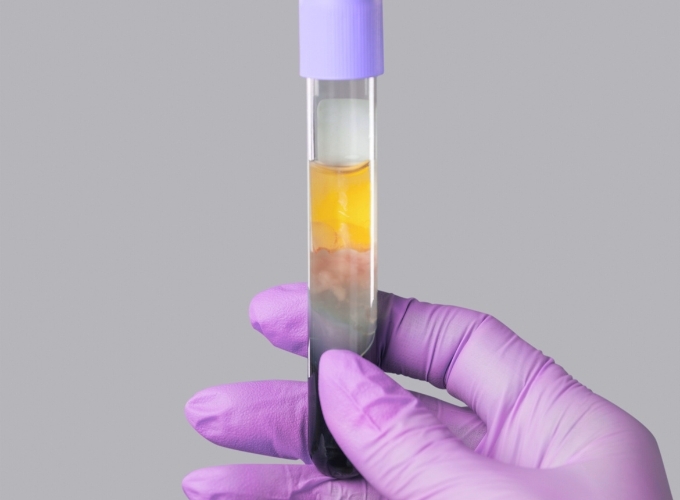 What to Expect from your PRP Treatment for Under Eyes and Lips