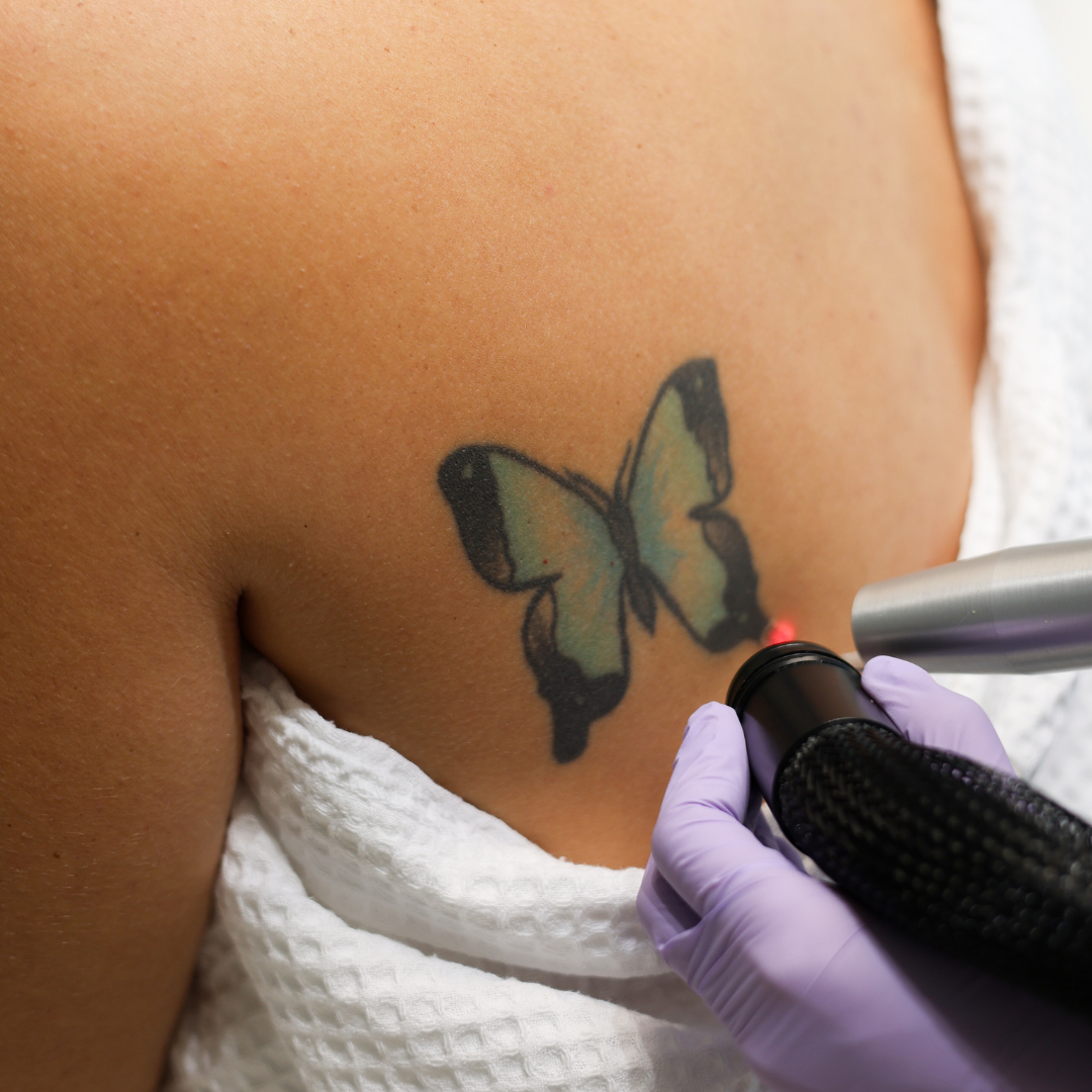 ****12 Days of WIFHmas - Laser Tattoo Removal - $250 Deposit - Image 2