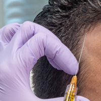 PRP Hair Restoration
