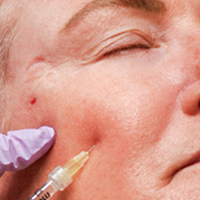 Restylane® FAQs