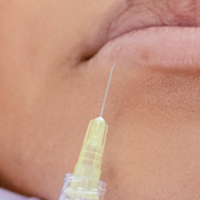 Sculptra® FAQs