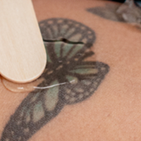 Laser Tattoo Removal FAQs