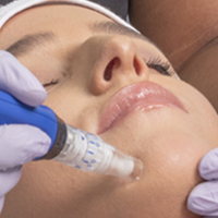 Microneedling FAQs