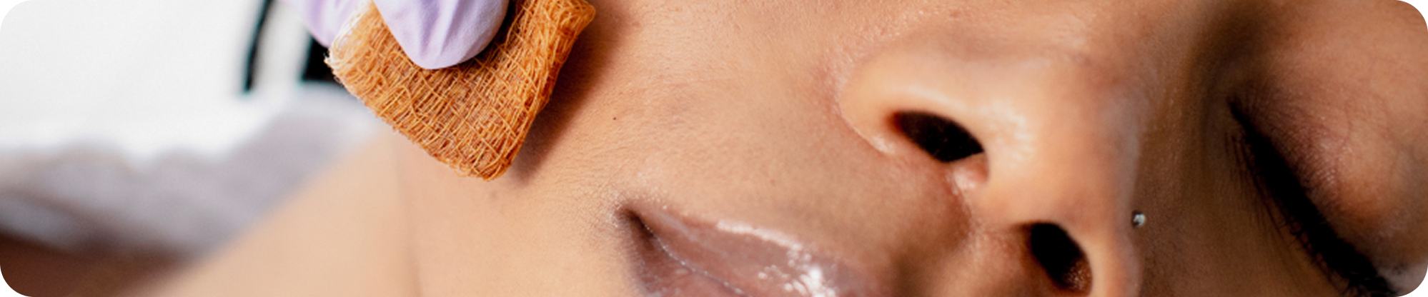 Chemical Peels